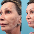 Who should not get laser resurfacing?