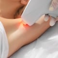 Can laser cause a fever?