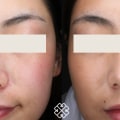 How long does it take to see results from facial laser?