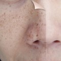 What is the average cost of laser resurfacing?