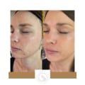 Is skin laser treatment permanent?
