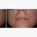 How much does it cost to have your whole face lasered?