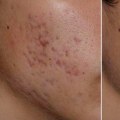 What are the disadvantages of skin laser treatment?