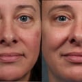 How long do the results of laser resurfacing last?