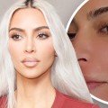 Does kim kardashian do fraxel?