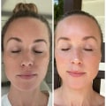 Are skin laser treatments worth it?