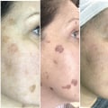 Is laser actually good for your skin?