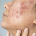 Can laser skin treatment go wrong?