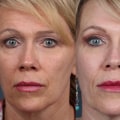 How often should i get laser skin resurfacing?