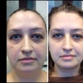 Is fraxel or co2 laser better for wrinkles?