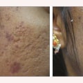 How much does laser treatment for skin cost?
