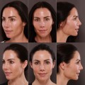 How long do skin laser results last?