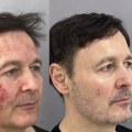 Can laser resurfacing cause skin cancer?