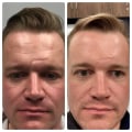 How much does fraxel repair cost?