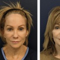 Do face lasers really make a difference?