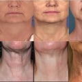 How long does laser neck tightening last?