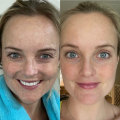 What's better, laser c02 or ultherapy for face?