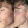How much does laser skin treatment cost?
