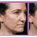 What is the best skin tightening procedure for over 60?