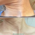 Do skin tightening lasers actually work?