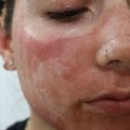 Are there any harmful long-term effects to laser?