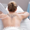 Is it normal to have a fever after laser tattoo removal?