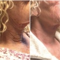 How much does laser neck tightening cost?
