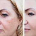 How long does fraxel laser last?