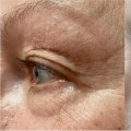 Is there anything better than co2 laser for wrinkles?
