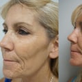 Is laser skin treatment risky?