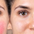 How to get rid of rosacea permanently?