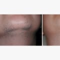 How much does it cost to have laser done on your face?
