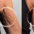 Which laser is best for crepey skin?