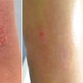 Are there negative effects of laser therapy?