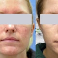 Does laser help rosacea?