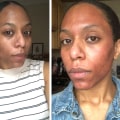 Is laser skin treatment worth the cost?