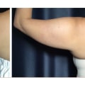 How much does laser skin tightening cost?