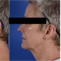 Who is not a good candidate for laser resurfacing?