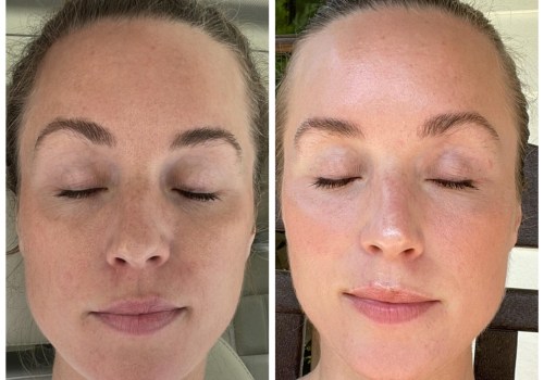 How much does moxi laser treatment cost?