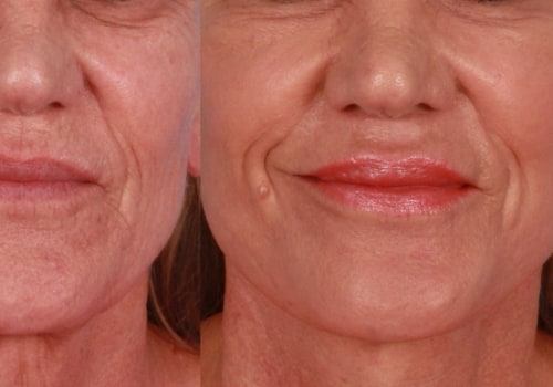 What is better than co2 laser for face?