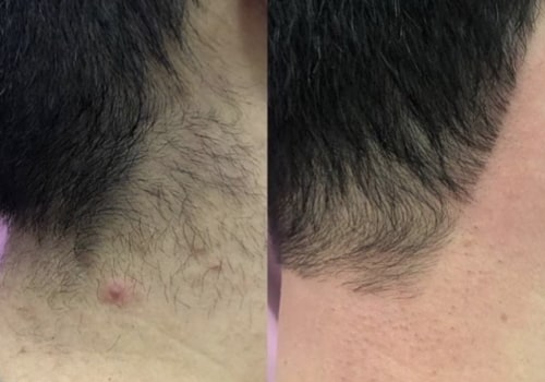 How many laser sessions do you need for your neck?