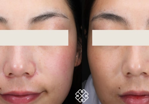 How long does it take to see results from facial laser?