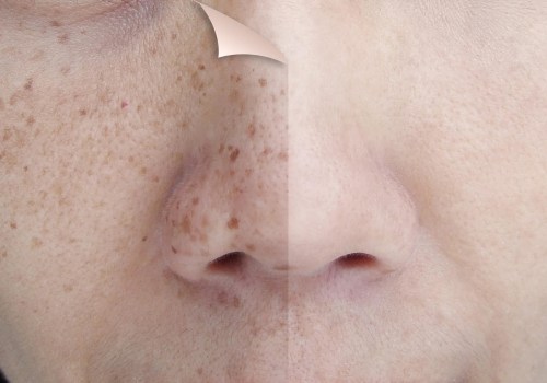 What is the average cost of laser resurfacing?