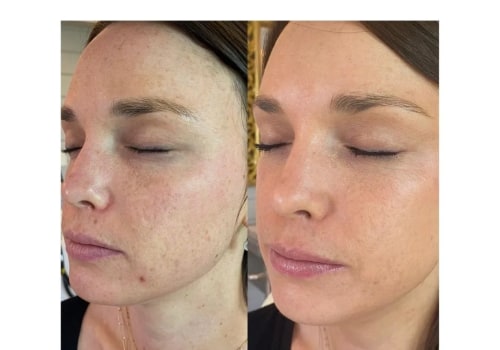 Is skin laser treatment permanent?