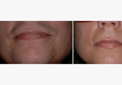 How much does it cost to have your whole face lasered?