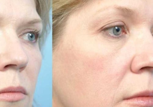 What are two drawbacks of laser therapy?