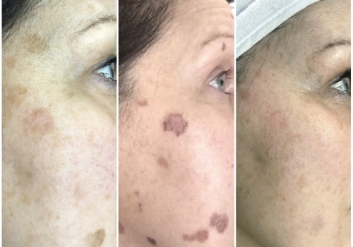 Does laser have side effects on skin?