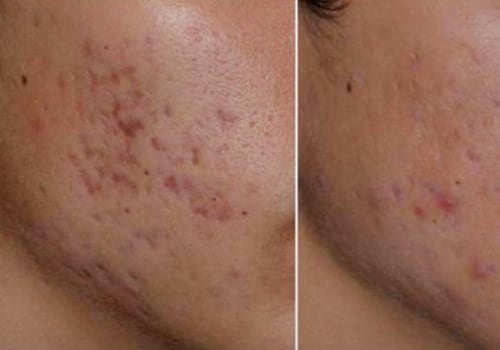What are the disadvantages of skin laser treatment?