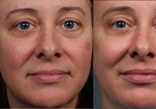 How long do the results of laser resurfacing last?