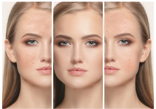 How much should a laser treatment cost?